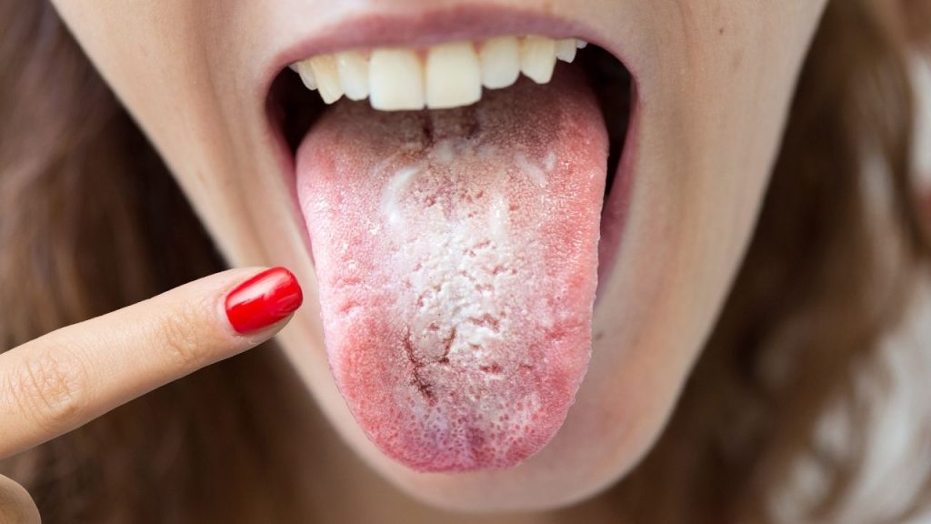 Home Remedies for Oral Thrush